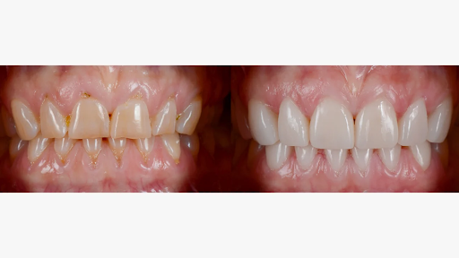 teeth-whitening - Newark Family Dental